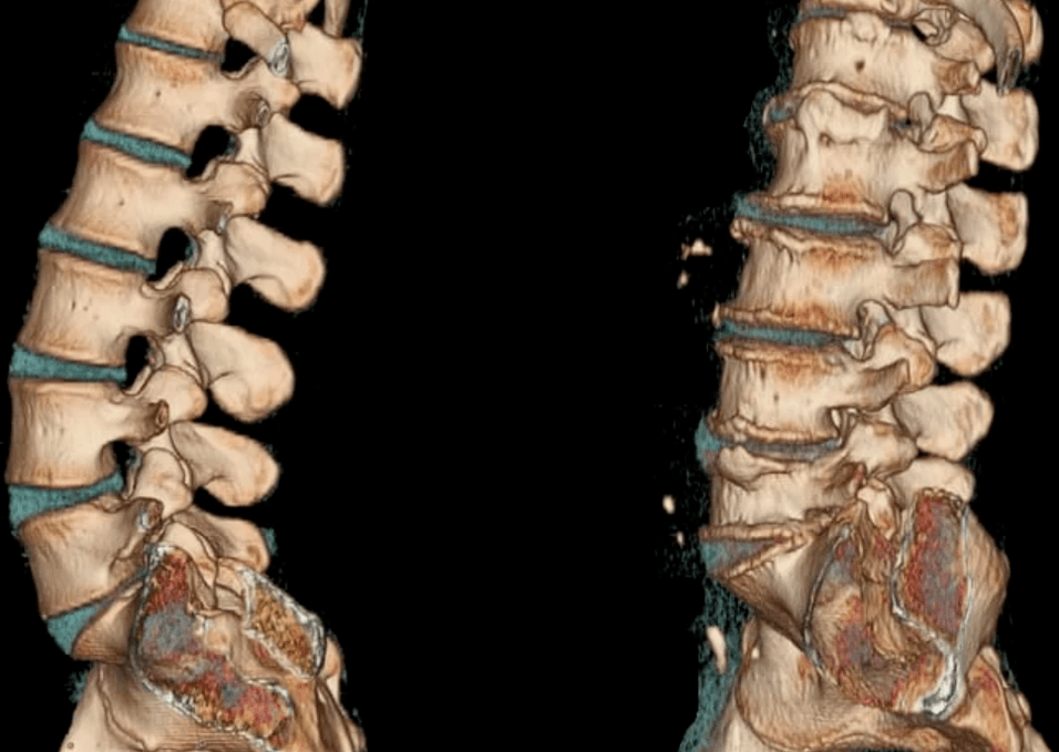 Osteochonds