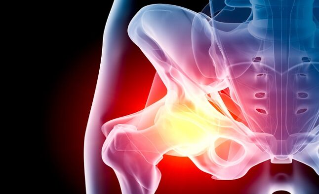 Arthrosis vum Hip Gelenk