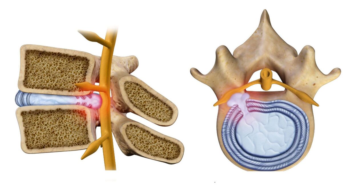 Spinal Hernia bei der thoracescher Osteochondrose