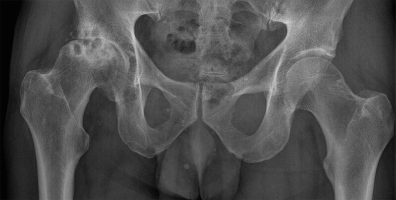 Deforméierend Arthrosis vum Hip Gelenk op Röntgen
