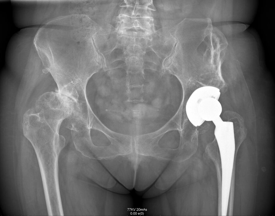 Röntgen vum Hip Gelenk no Arthroplastik