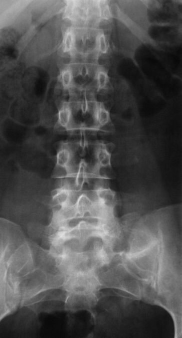 Fir d’Lendeger Osteochondrose ze diagnostizéieren, gëtt Radiographie gemaach