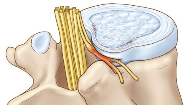 Lumbar Osteochondrose kann zu Komplikatiounen a Form vun intervertebral Hernia féieren