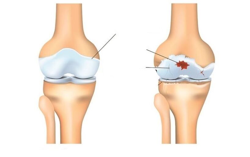 Gesond a Patient mat Arthrosis Gelenker